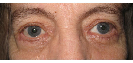 Eyelid Surgery Blepharoplasty Washington DC Maryland Northern Virginia