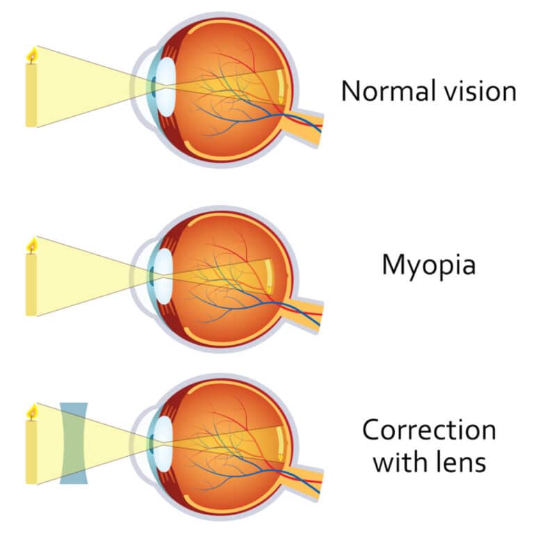 What Does Myopia In Spanish Mean